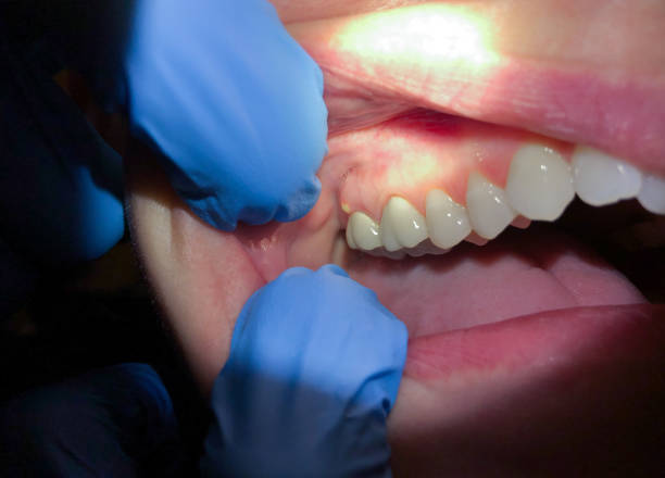 Best Emergency Treatment for Dental Infections or Abscesses in Waterloo, IN