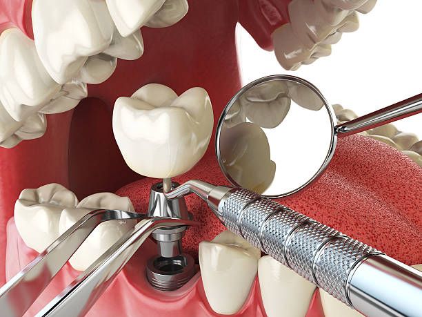 Best Emergency Tooth Extraction in Waterloo, IN